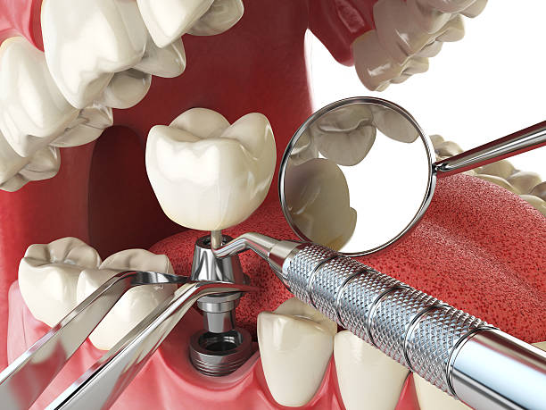 Best Emergency Tooth Extraction in Wtell, LA